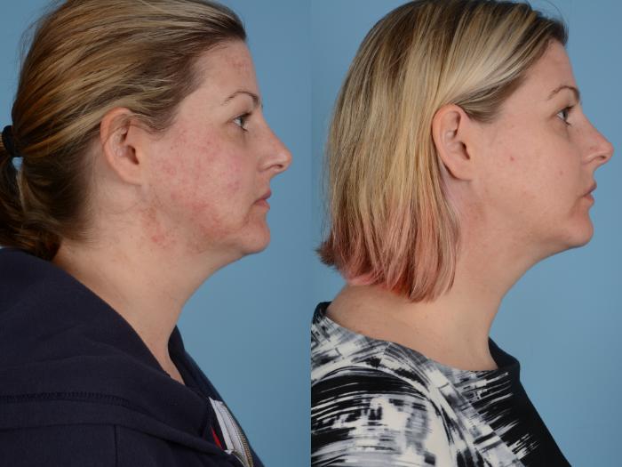 Before & After Facial Rejuvenation  and Skincare Case 117 View #3 View in Waterloo, Ontario