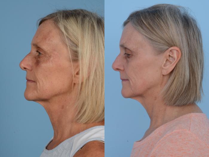 Before & After Facial Rejuvenation  and Skincare Case 153 View #2 View in Waterloo, Ontario