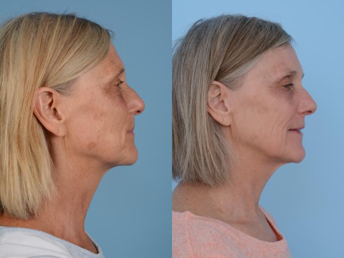 Before & After Facial Rejuvenation  and Skincare Case 153 View #3 View in Waterloo, Ontario
