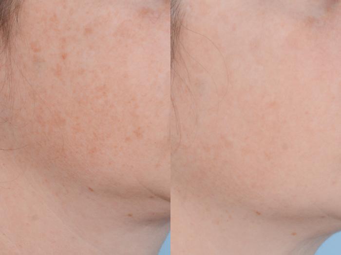 Before & After Facial Rejuvenation  and Skincare Case 494 View #2 View in Waterloo, Ontario