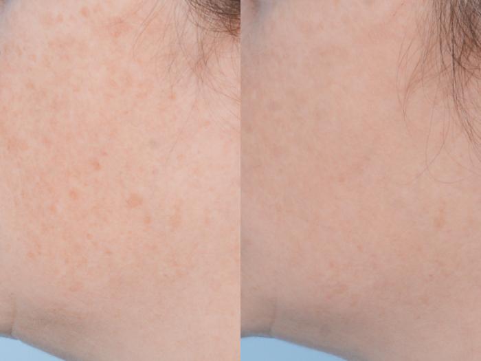 Before & After Facial Rejuvenation  and Skincare Case 494 View #3 View in Waterloo, Ontario