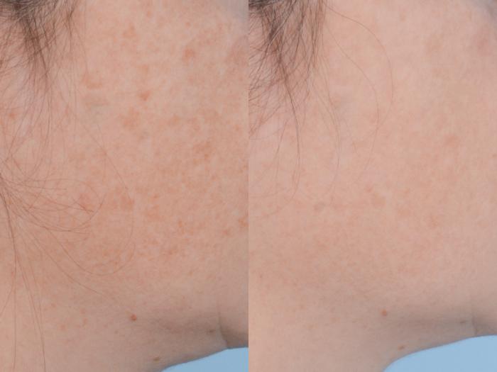 Before & After Facial Rejuvenation  and Skincare Case 494 View #4 View in Waterloo, Ontario