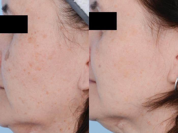 Before & After Laser Procedures Case 530 View #2 View in Waterloo, Ontario