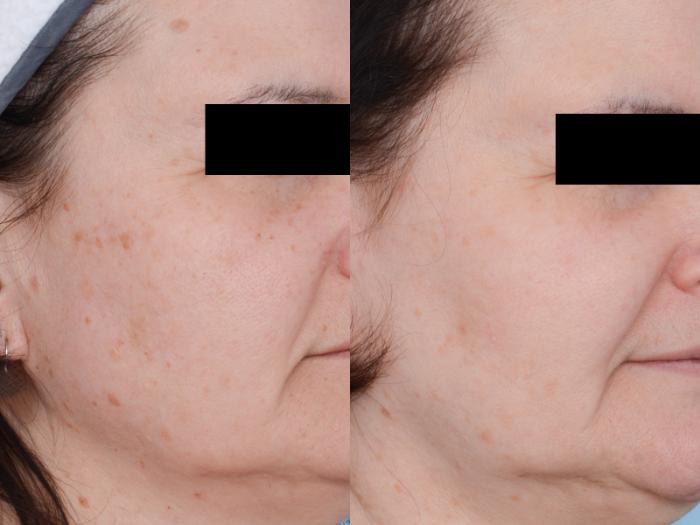 Before & After Laser Procedures Case 530 View #3 View in Waterloo, Ontario