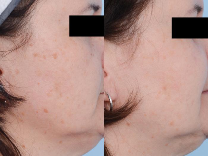 Before & After Laser Procedures Case 530 View #4 View in Waterloo, Ontario