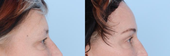 Before & After Facial Rejuvenation  and Skincare Case 619 View #10 View in Waterloo, Ontario