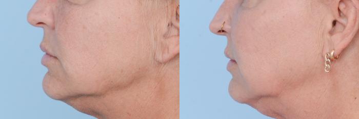 Before & After Facial Rejuvenation  and Skincare Case 619 View #2 View in Waterloo, Ontario