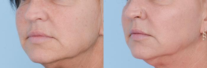 Before & After Facial Rejuvenation  and Skincare Case 619 View #3 View in Waterloo, Ontario