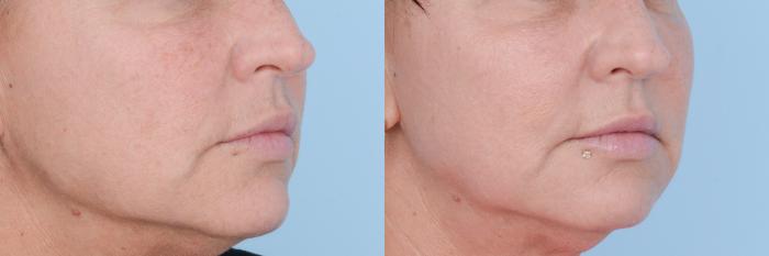 Before & After Facial Rejuvenation  and Skincare Case 619 View #4 View in Waterloo, Ontario