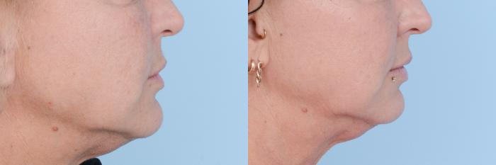 Before & After Facial Rejuvenation  and Skincare Case 619 View #5 View in Waterloo, Ontario