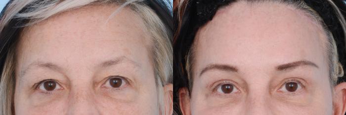 Before & After Facial Rejuvenation  and Skincare Case 619 View #6 View in Waterloo, Ontario