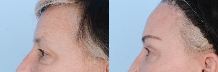 Before & After Facial Rejuvenation  and Skincare Case 619 View #7 View in Waterloo, Ontario