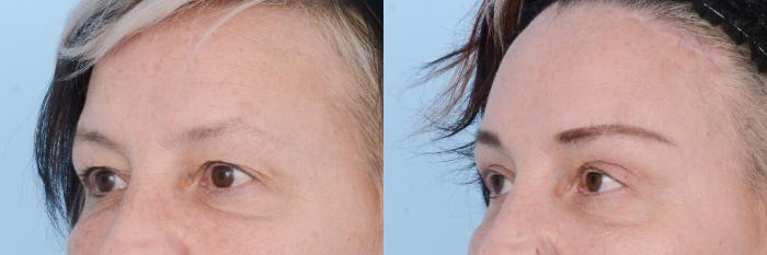 Before & After Facial Rejuvenation  and Skincare Case 619 View #8 View in Waterloo, Ontario