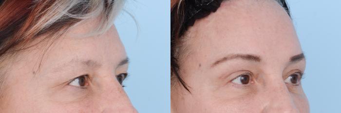Before & After Facial Rejuvenation  and Skincare Case 619 View #9 View in Waterloo, Ontario