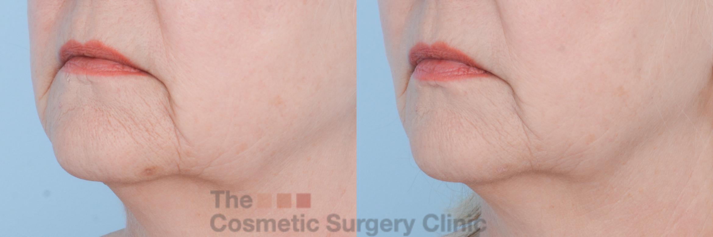 Before & After InstaLift Case 467 View #2 View in Waterloo, Ontario