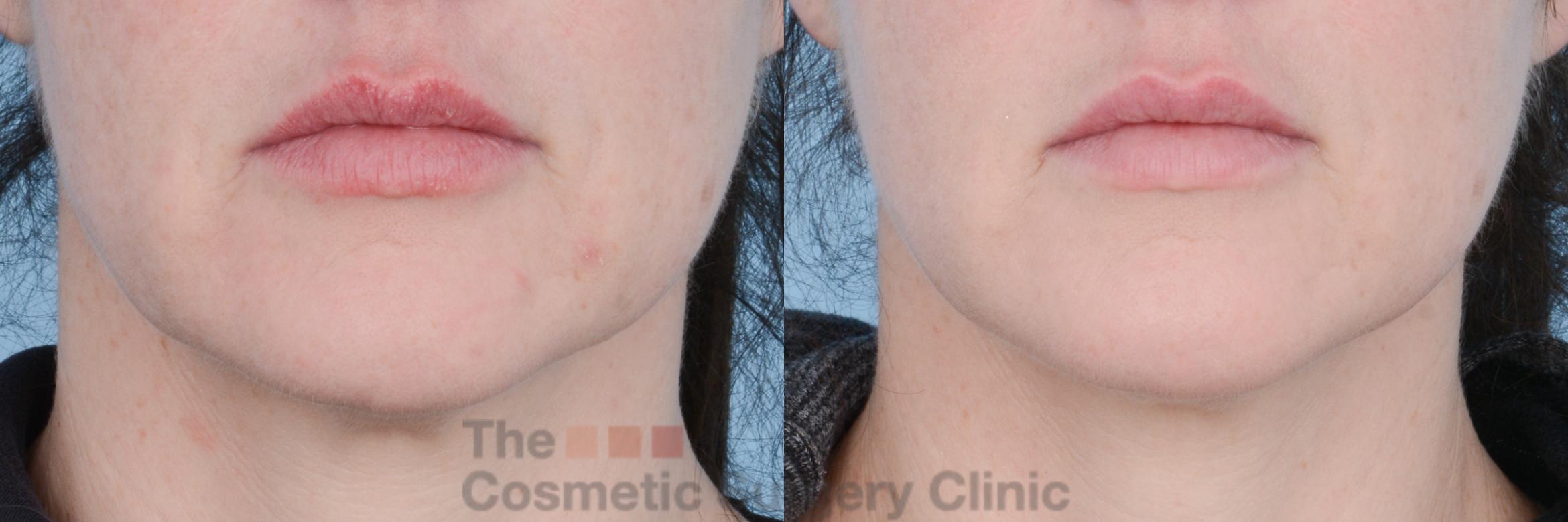 Before & After InstaLift Case 559 View #3 View in Waterloo, Ontario