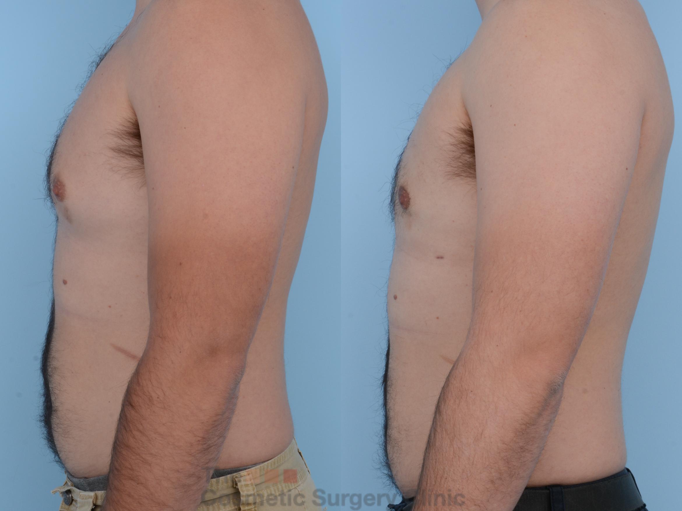 Male Breast Reduction / Gynecomastia Before and After Pictures Case 226 ...