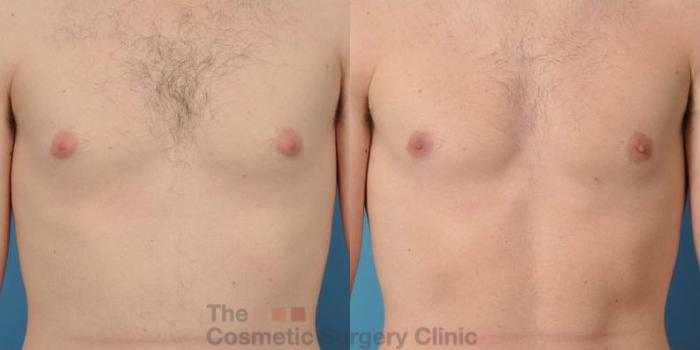 Before & After Male Breast Reduction / Gynecomastia Case 36 View #2 View in Waterloo, Ontario