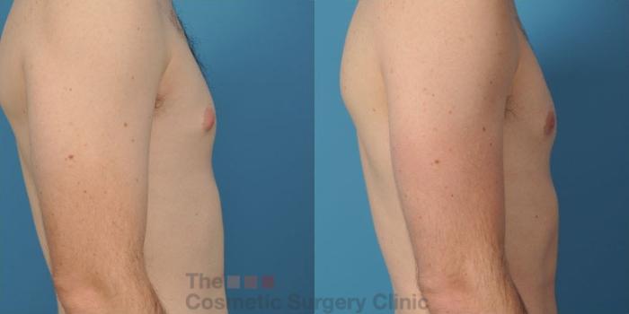 Before & After Male Breast Reduction / Gynecomastia Case 36 View #3 View in Waterloo, Ontario