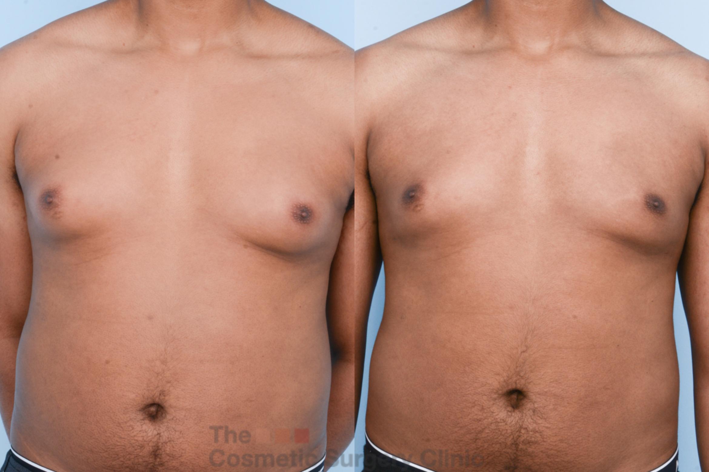 Before & After Male Breast Reduction / Gynecomastia Case 428 View #1 View in Waterloo, Ontario