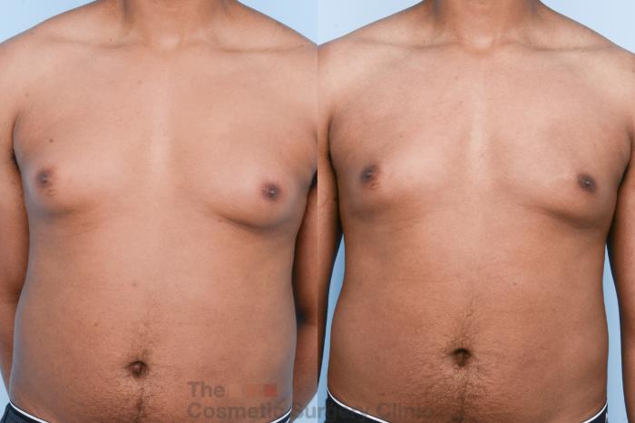 Before & After Male Breast Reduction / Gynecomastia Case 428 View #1 View in Waterloo, Ontario