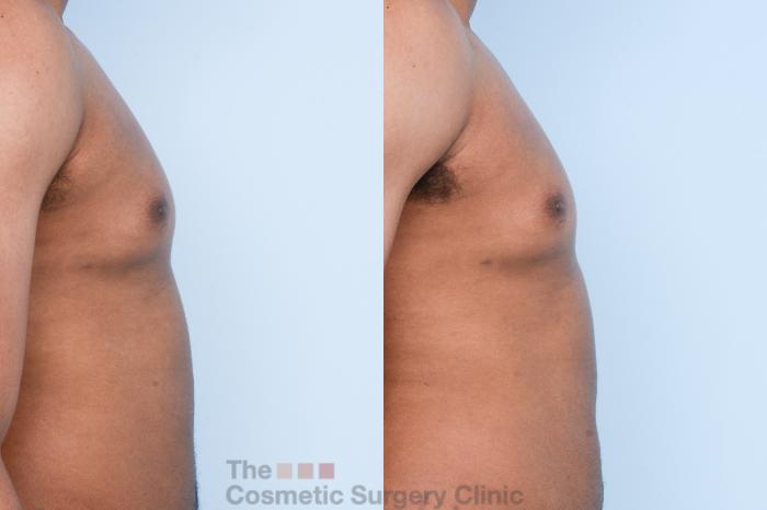 Before & After Male Breast Reduction / Gynecomastia Case 428 View #10 View in Waterloo, Ontario