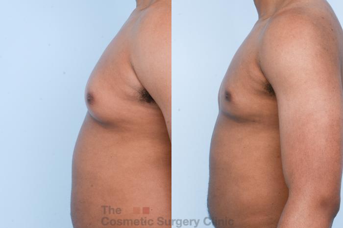 Before & After Male Breast Reduction / Gynecomastia Case 428 View #2 View in Waterloo, Ontario