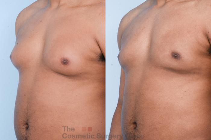 Before & After Male Breast Reduction / Gynecomastia Case 428 View #3 View in Waterloo, Ontario