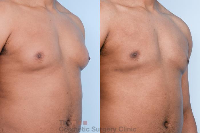 Before & After Male Breast Reduction / Gynecomastia Case 428 View #4 View in Waterloo, Ontario