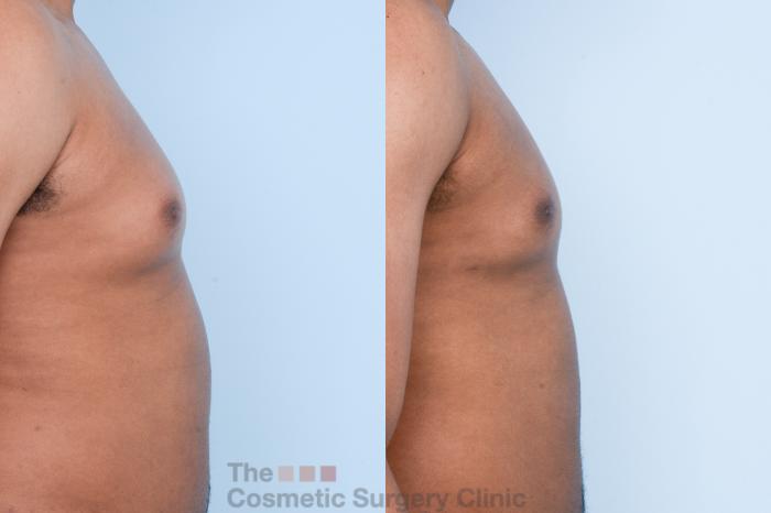 Before & After Male Breast Reduction / Gynecomastia Case 428 View #5 View in Waterloo, Ontario
