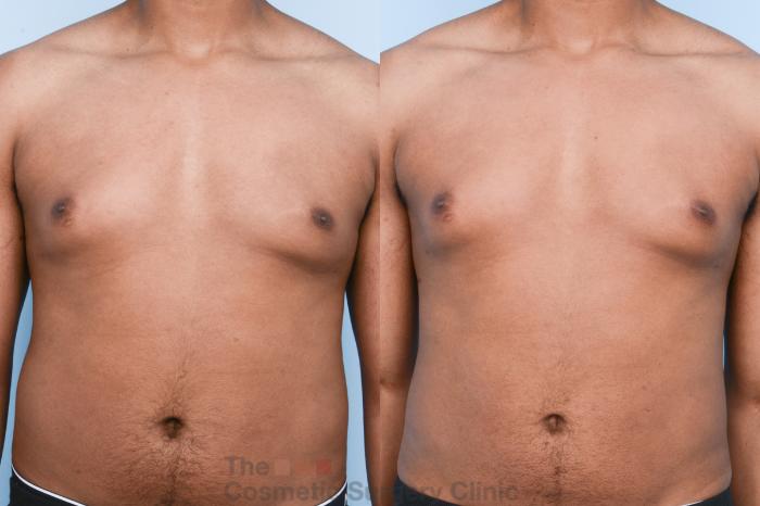 Before & After Male Breast Reduction / Gynecomastia Case 428 View #6 View in Waterloo, Ontario