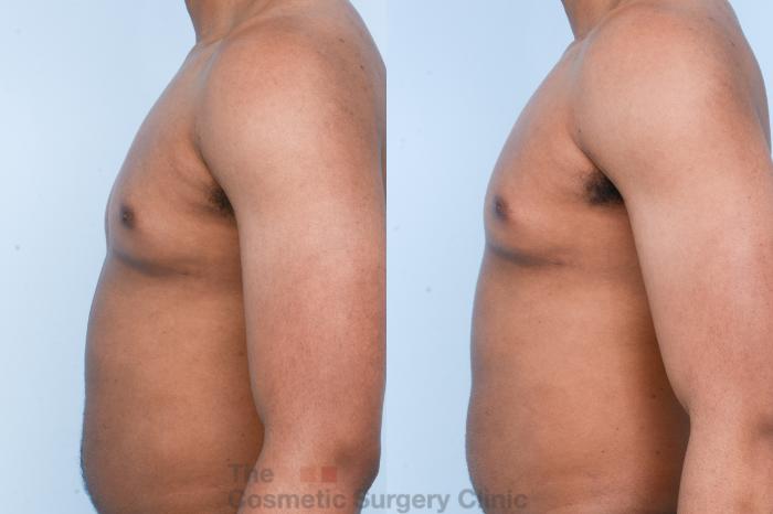 Before & After Male Breast Reduction / Gynecomastia Case 428 View #7 View in Waterloo, Ontario