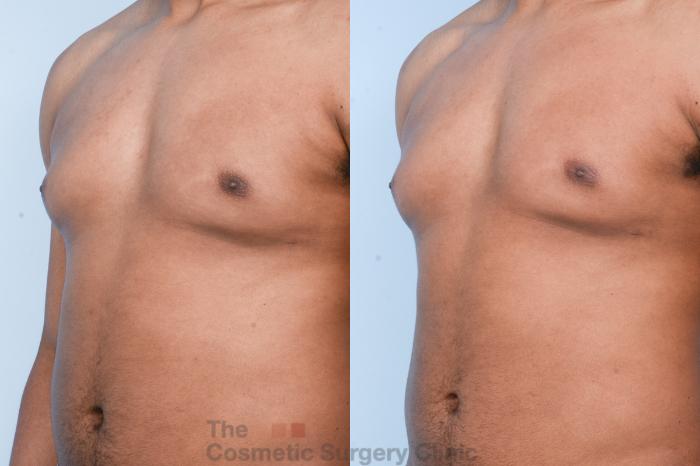 Before & After Male Breast Reduction / Gynecomastia Case 428 View #8 View in Waterloo, Ontario