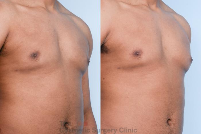 Before & After Male Breast Reduction / Gynecomastia Case 428 View #9 View in Waterloo, Ontario