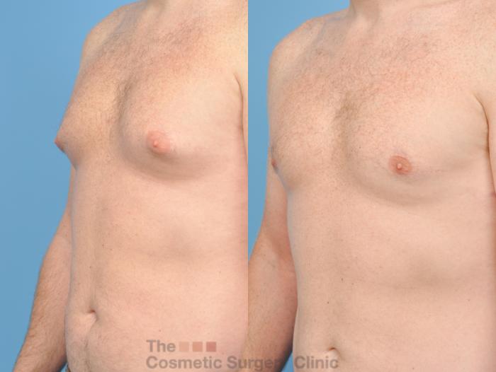 Before & After Male Breast Reduction / Gynecomastia Case 43 View #2 View in Waterloo, Ontario