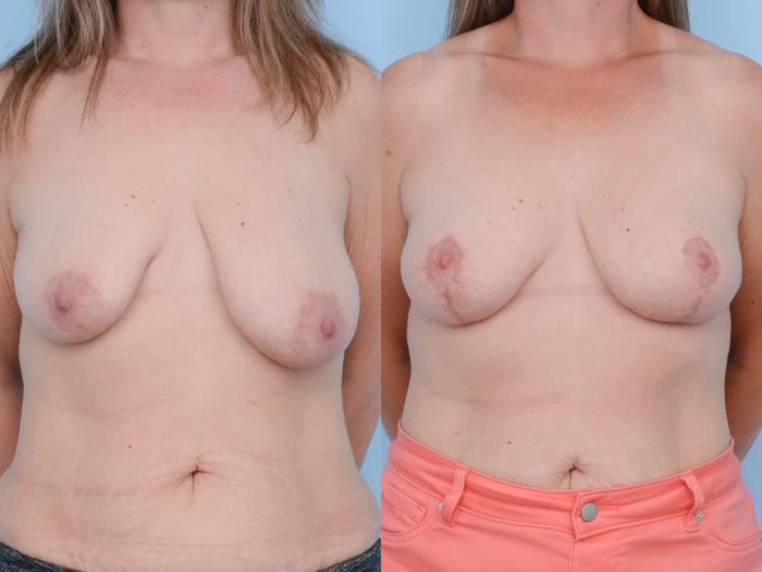 Before & After Breast Lift Case 416 View #1 View in Waterloo, Ontario