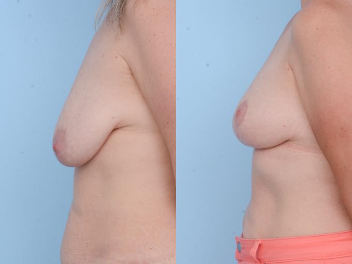 Before & After Breast Lift Case 416 View #2 View in Waterloo, Ontario