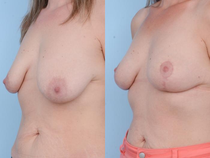 Before & After Breast Lift Case 416 View #3 View in Waterloo, Ontario
