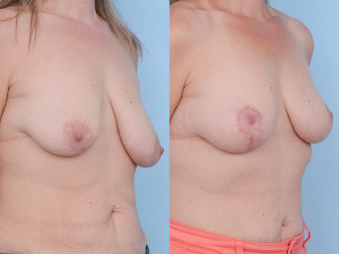 Before & After Breast Lift Case 416 View #4 View in Waterloo, Ontario