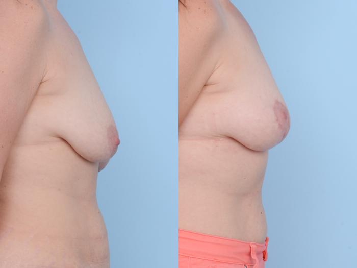 Before & After Breast Lift Case 416 View #5 View in Waterloo, Ontario