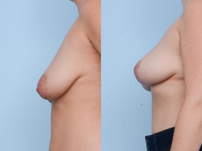 Before & After Breast Lift Case 499 View #2 View in Waterloo, Ontario