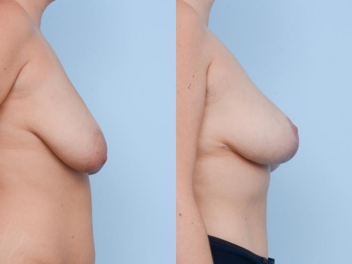 Before & After Breast Lift Case 499 View #5 View in Waterloo, Ontario