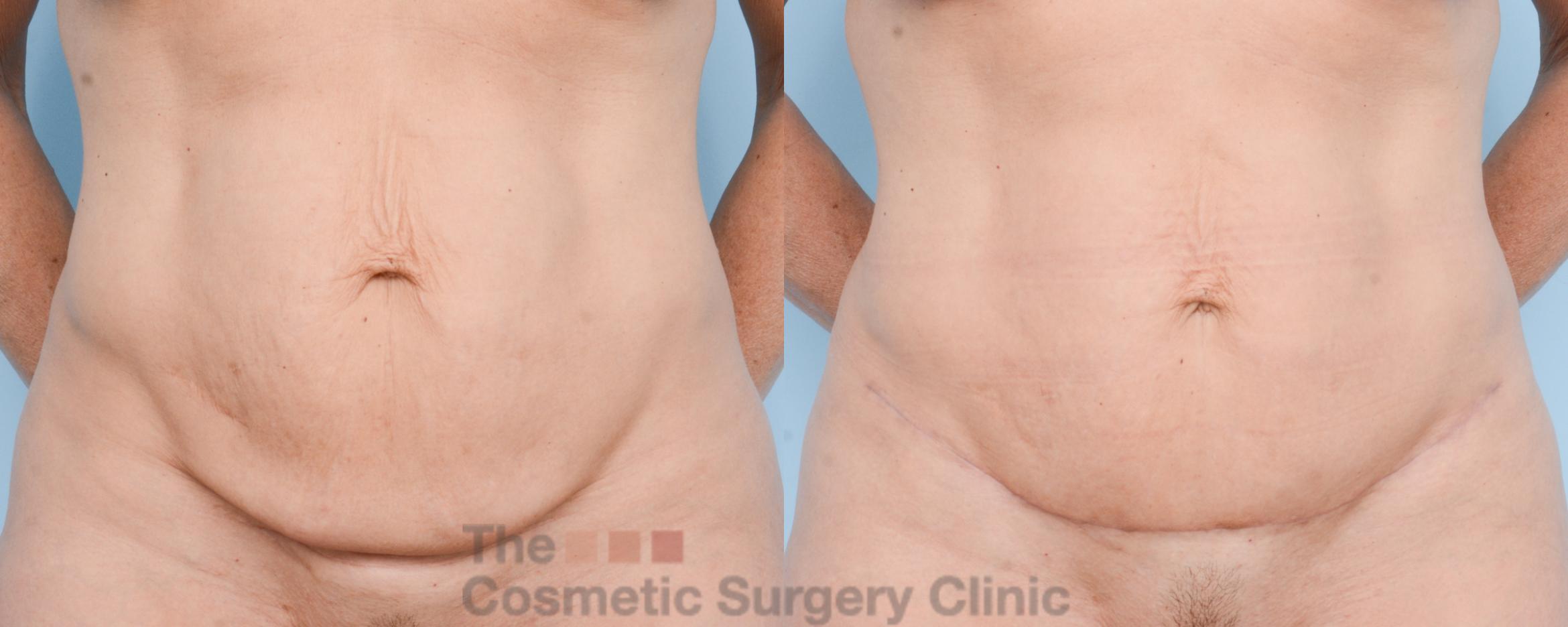 Before & After Mini-Tummy Tuck Case 803 Front View in Waterloo, Ontario