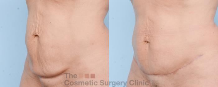 Before & After Mini-Tummy Tuck Case 803 Left Oblique View in Waterloo, Ontario