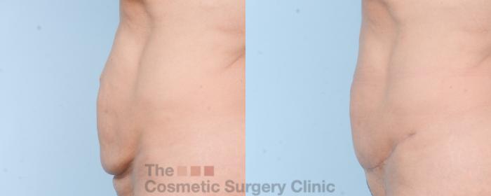 Before & After Mini-Tummy Tuck Case 803 Left Side View in Waterloo, Ontario