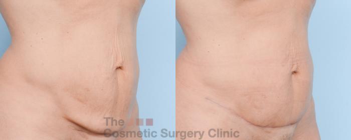 Before & After Mini-Tummy Tuck Case 803 Right Oblique View in Waterloo, Ontario