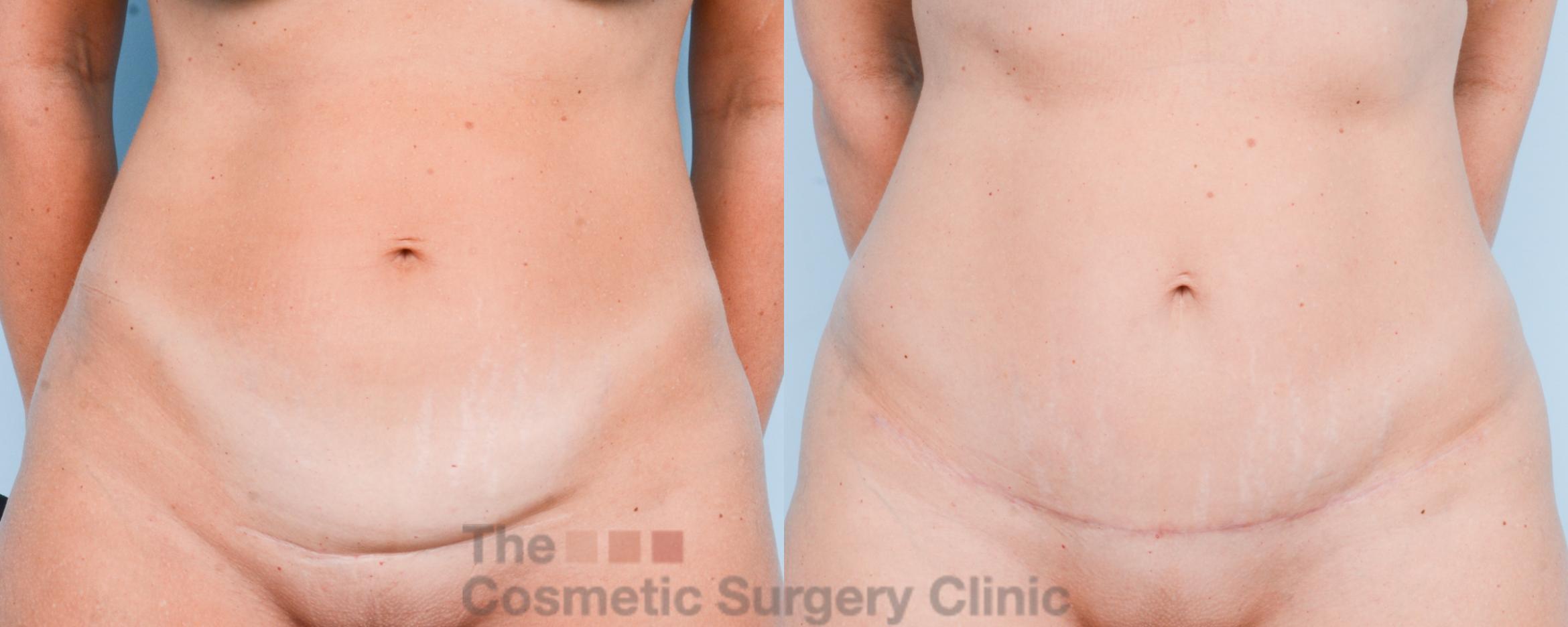 Before & After Mini-Tummy Tuck Case 867 Front View in Waterloo, Ontario