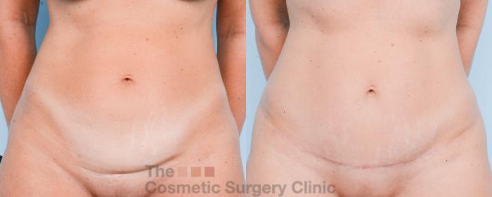 Before & After Mini-Tummy Tuck Case 867 Front View in Waterloo, Ontario