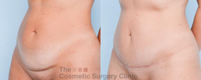 Before & After Mini-Tummy Tuck Case 867 Left Oblique View in Waterloo, Ontario