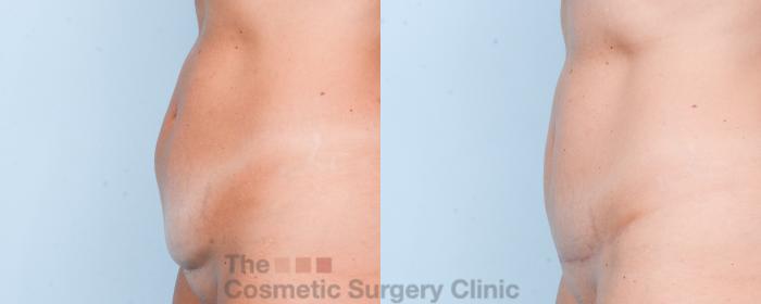 Before & After Mini-Tummy Tuck Case 867 Left Side View in Waterloo, Ontario